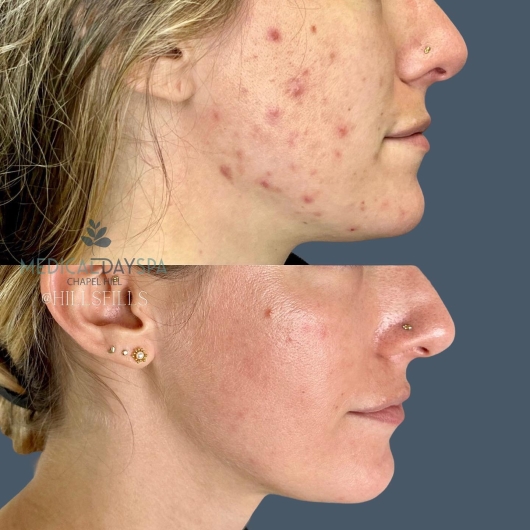 Acne Treatment and Scar Removal at Medical Day Spa Chapel Hill NC