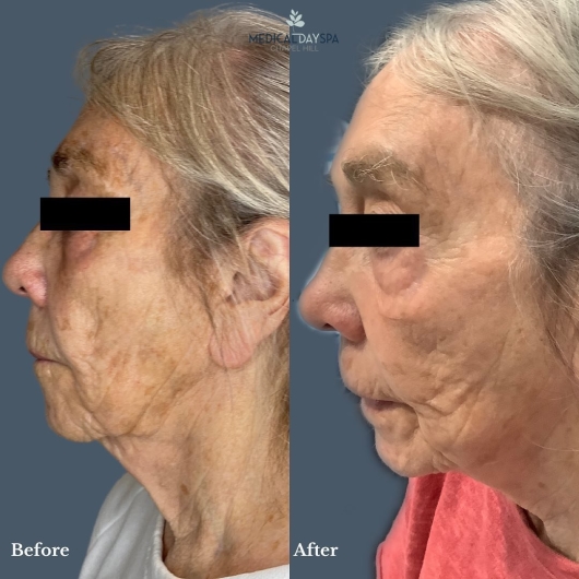 CO2 Laser Skin Resurfacing Before and After Medical Day Spa Chapel Hill NC
