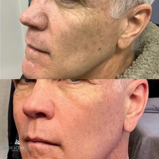 Fractional CO2 Laser Skin Resurfacing Before and After Medical Day Spa of Chapel Hill NC