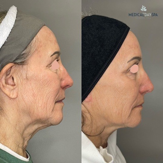 Fractional Laser Skin Resurfacing Before and After Medical Day Spa of Chapel Hill NC