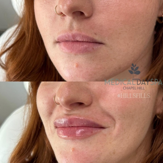 Lip Filler Before After - Medical Day Spa Chapel Hill NC